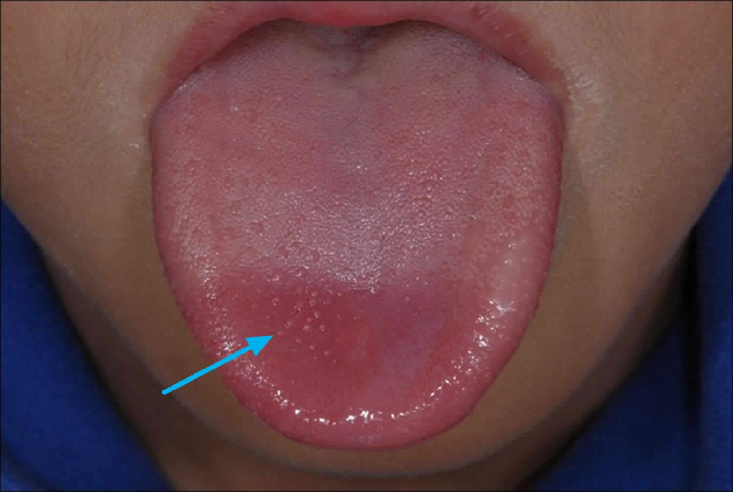 Sore Throat And Bumps On Tongue