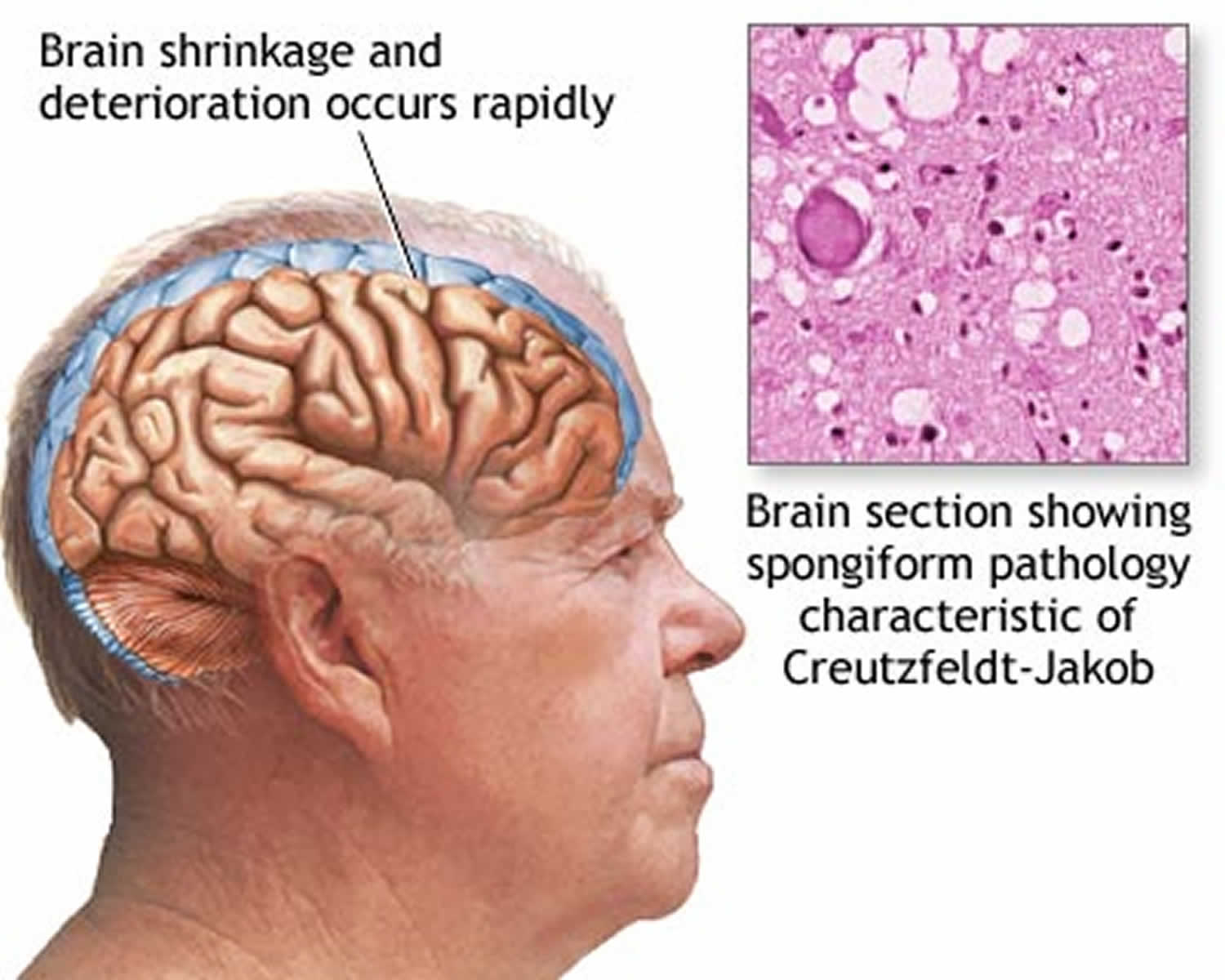 how-is-mad-cow-disease-in-humans-diagnosed-all-about-cow-photos