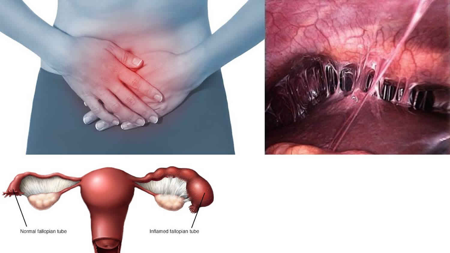 What Is Another Name For Pelvic Inflammatory