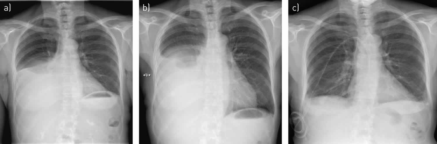 pleural effusion x ray lateral