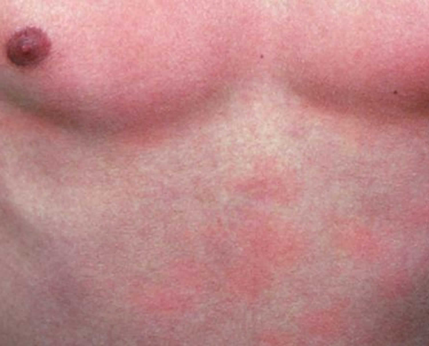 baby-heat-rash-types-diagnosis-and-treatment