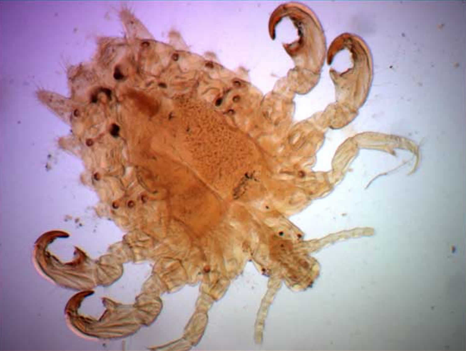 pubic-lice-or-crab-lice-signs-symptoms-transmission-pubic-lice