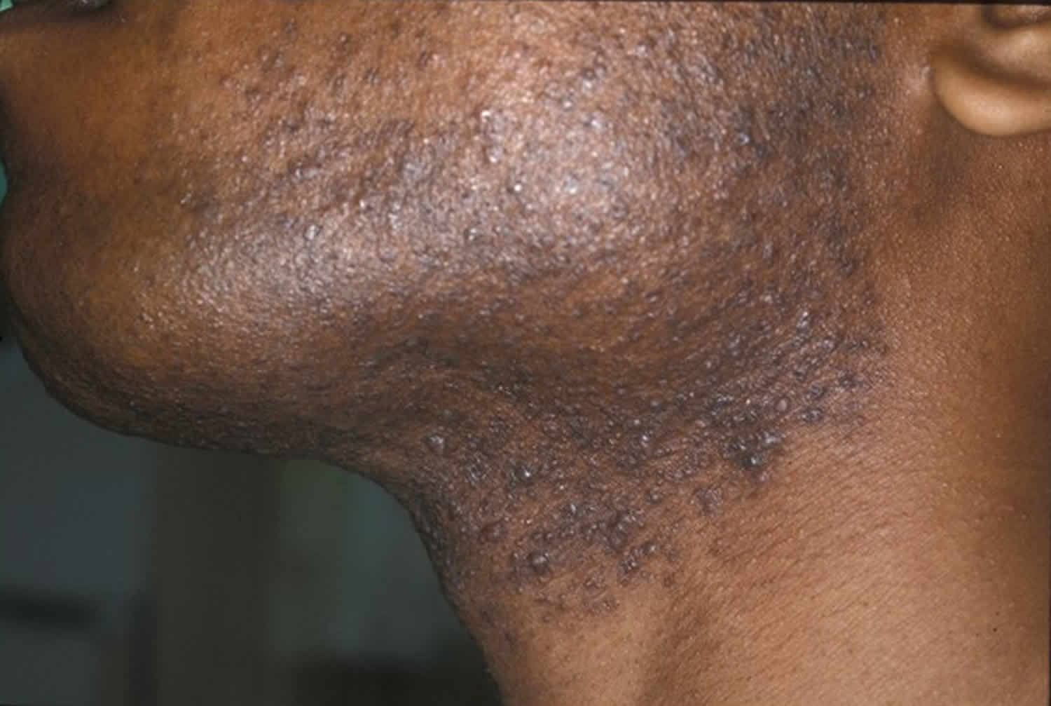 How To Get Rid Of Hair Bumps On The Back Of Your Neck