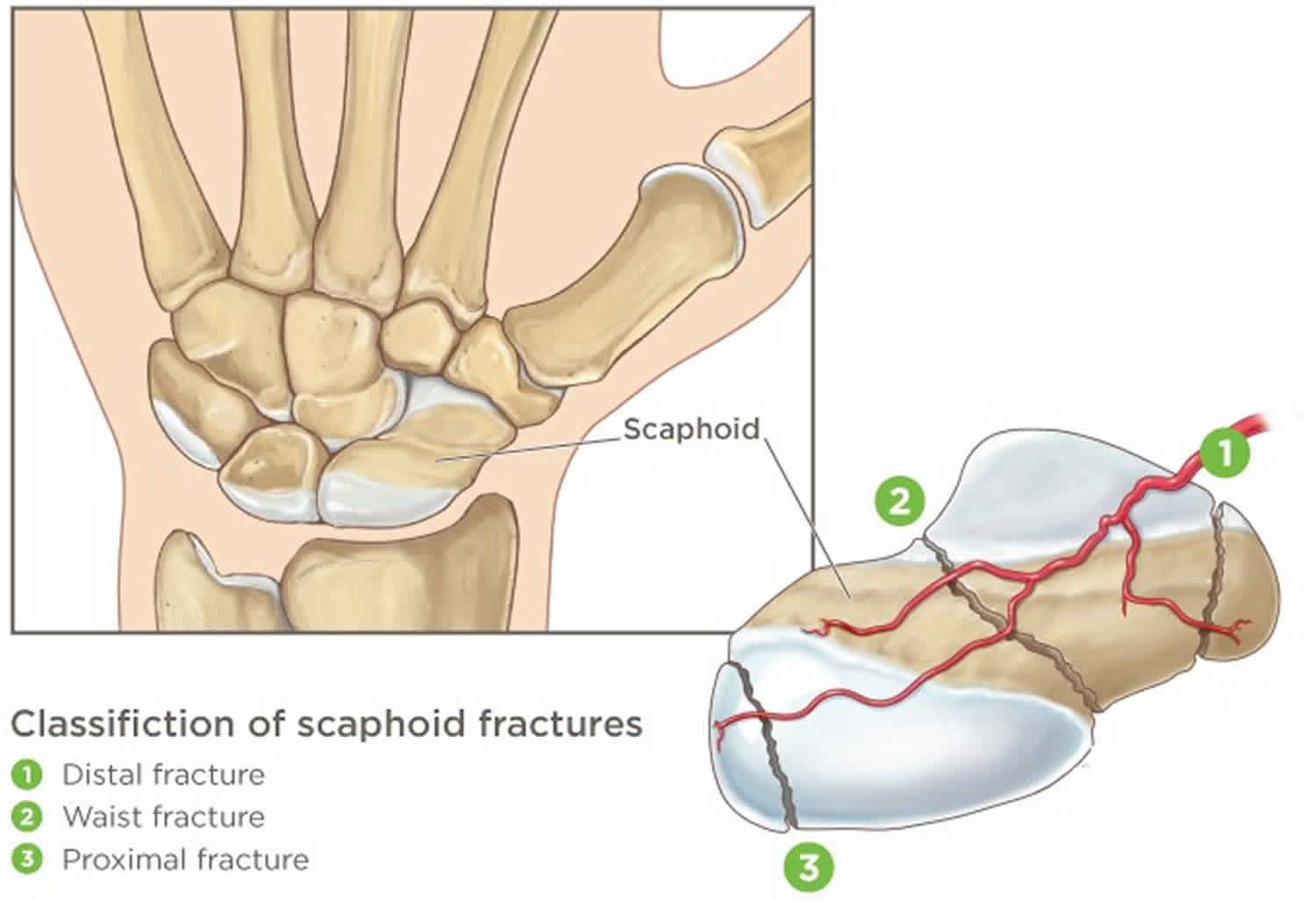 scaphoid pain but no fracture