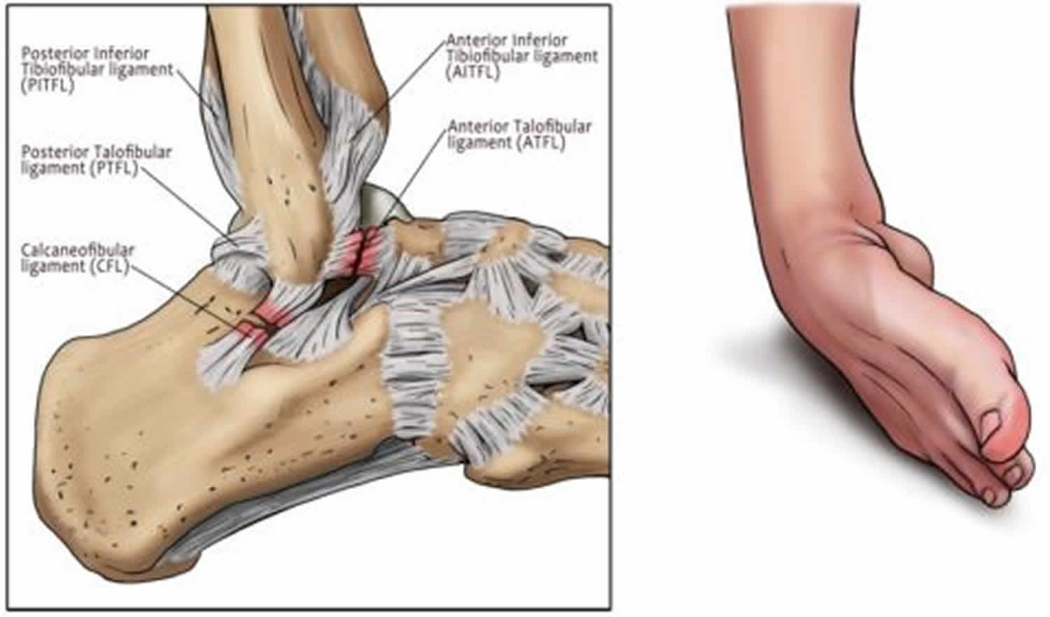 How to heal a knee sprain