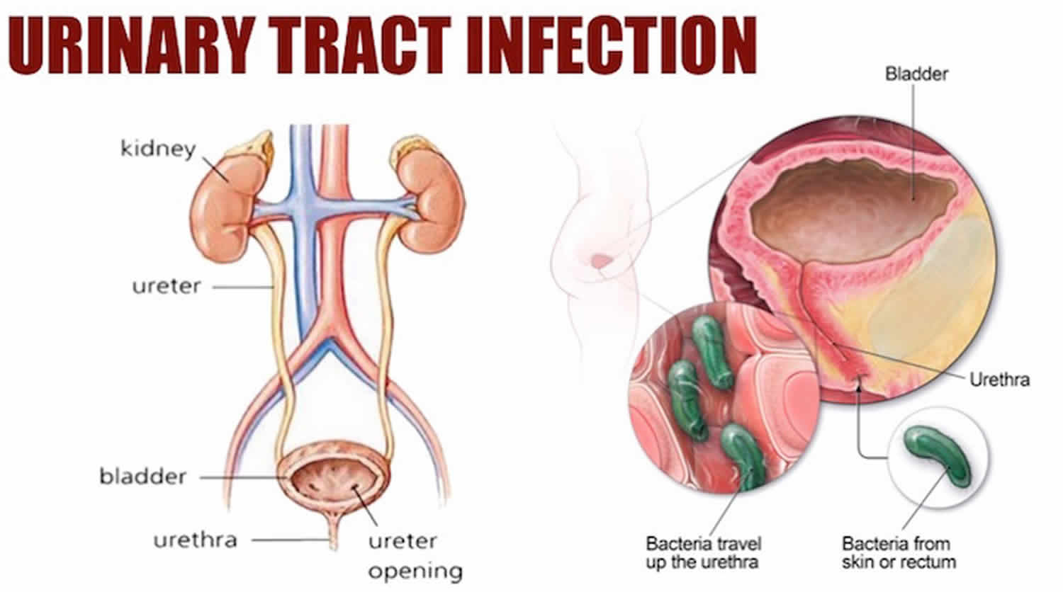 Urinary tract infection causes, symptoms, diagnosis