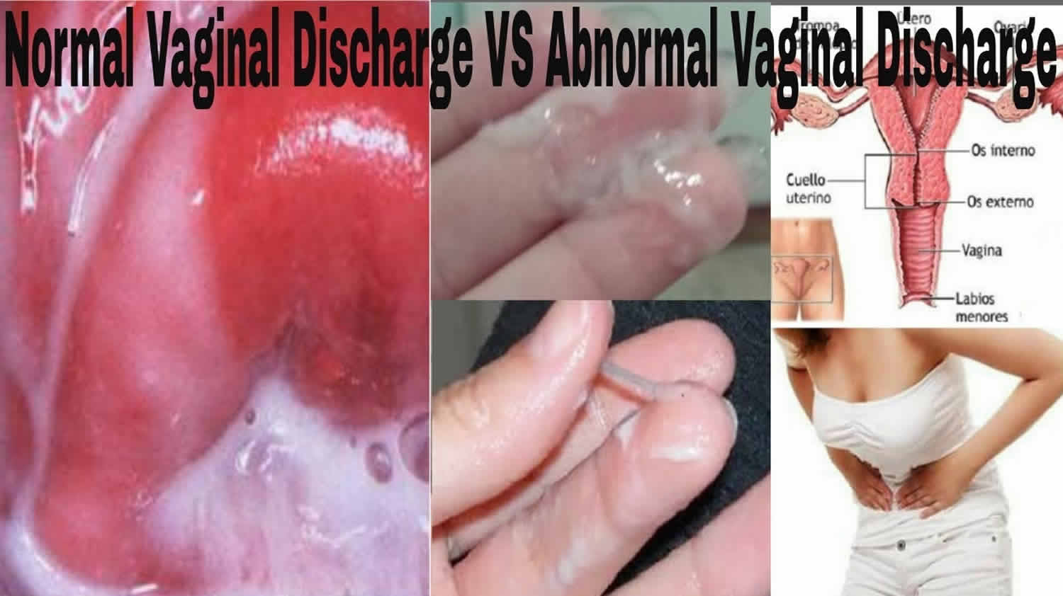 Types of vaginal discharge