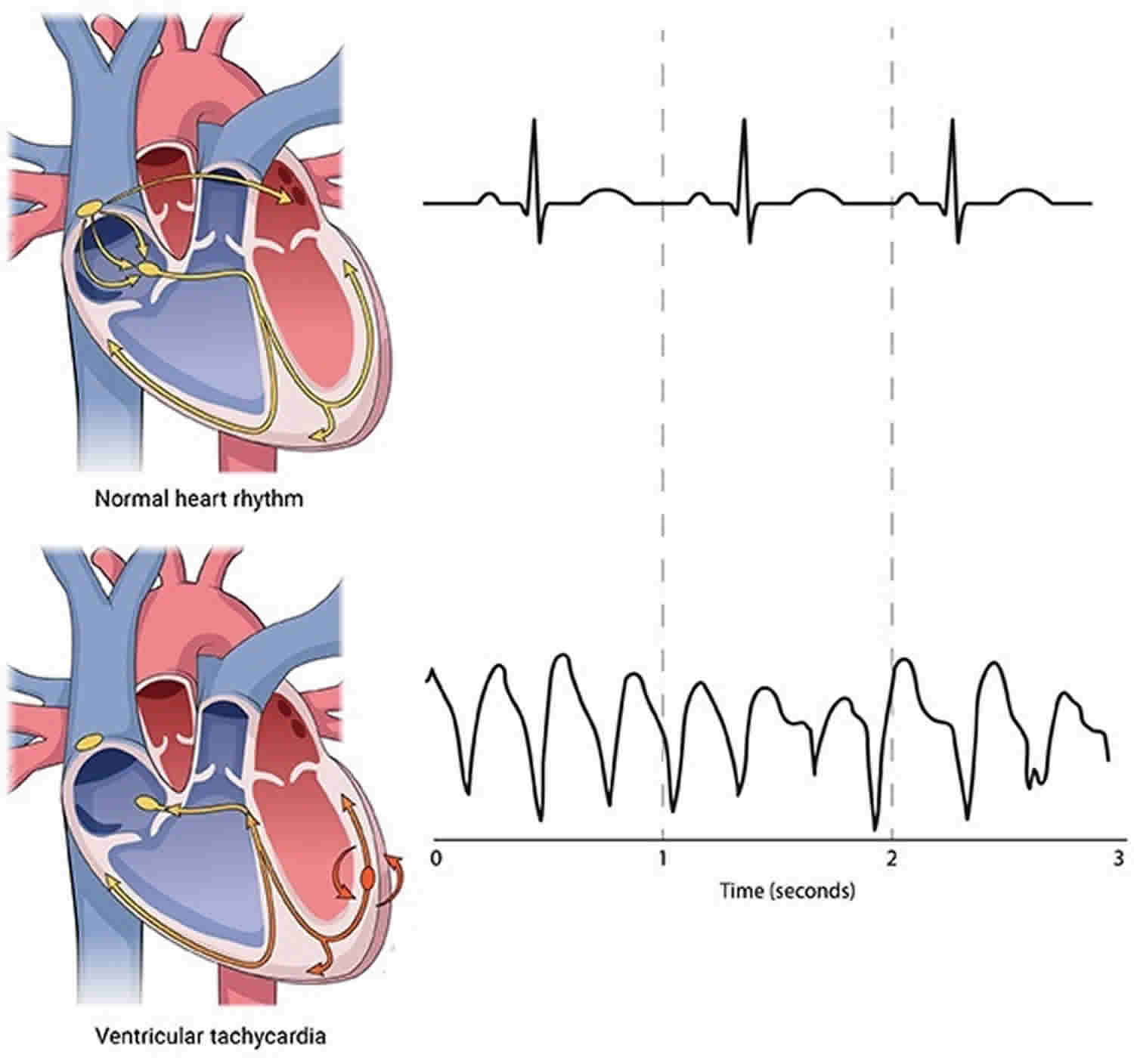 Ventricular tachycardia causes, symptoms, diagnosis, prognosis & treatment