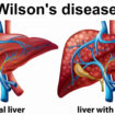 wilson’s disease