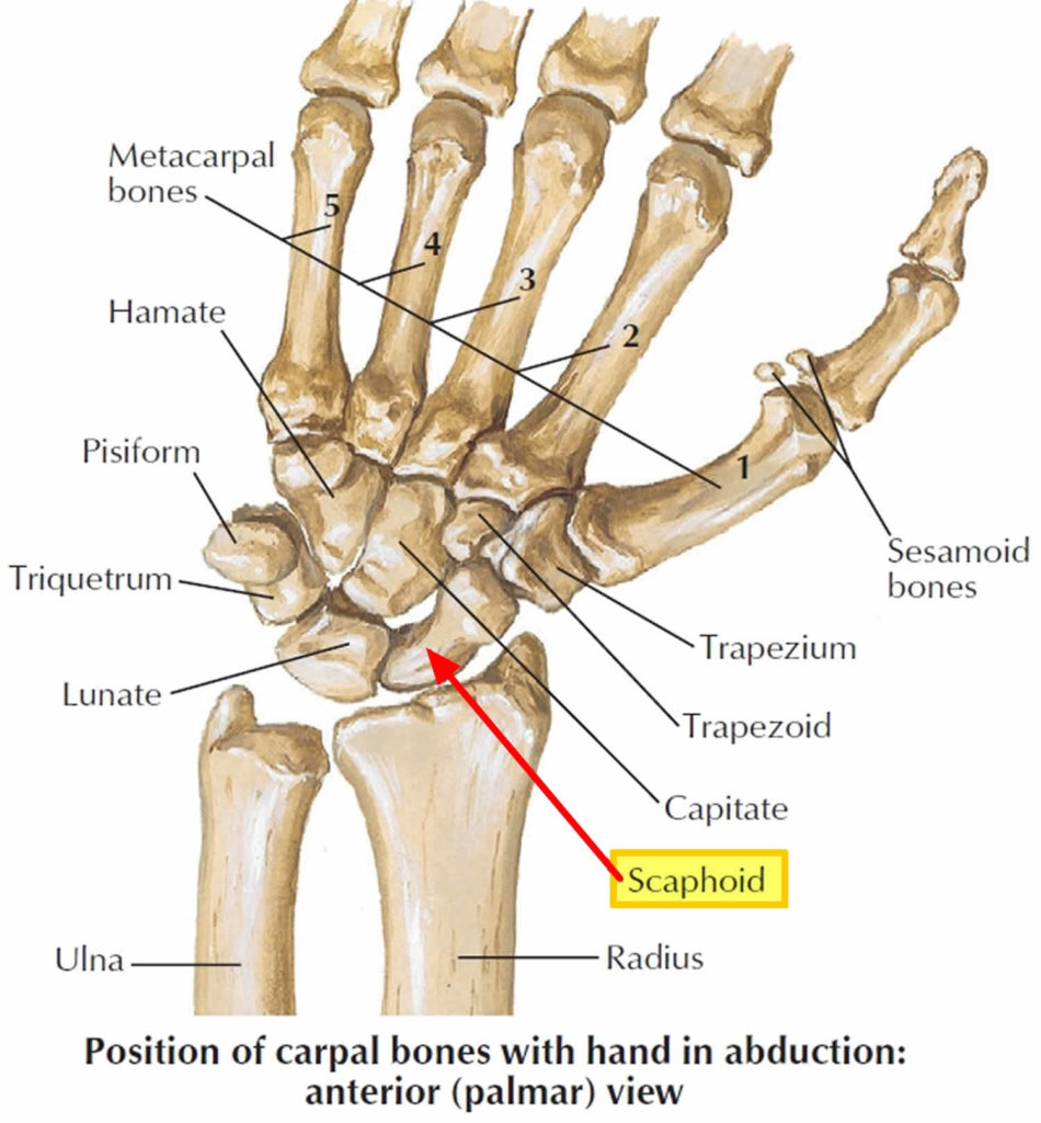 broken scaphoid bone