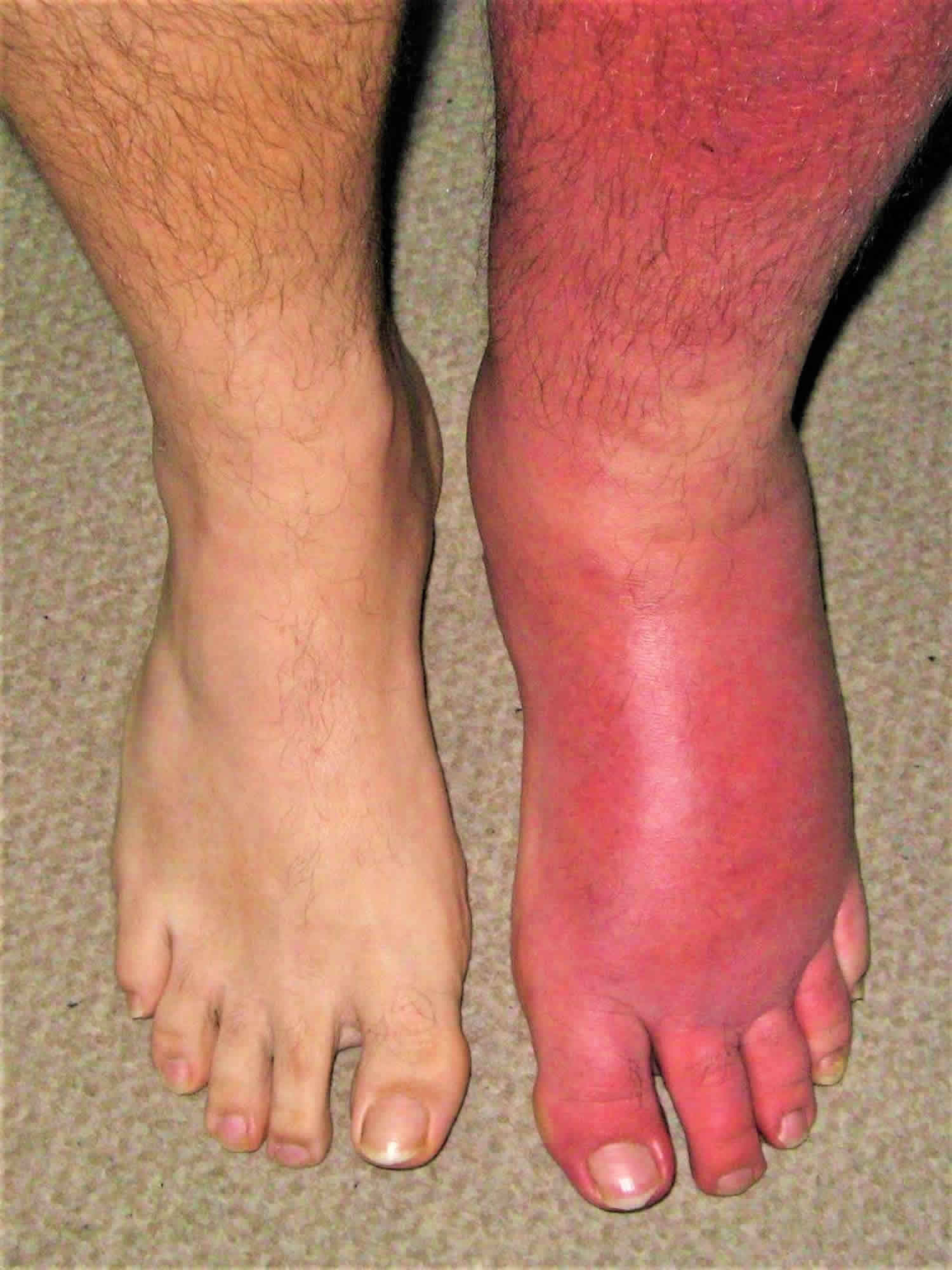 pictures of skin cellulitis
