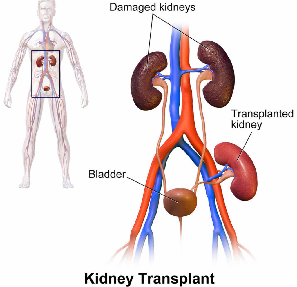 new research on kidney transplant