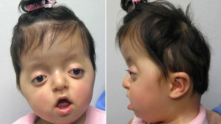 Pfeiffer syndrome causes, signs, symptoms, diagnosis & treatment