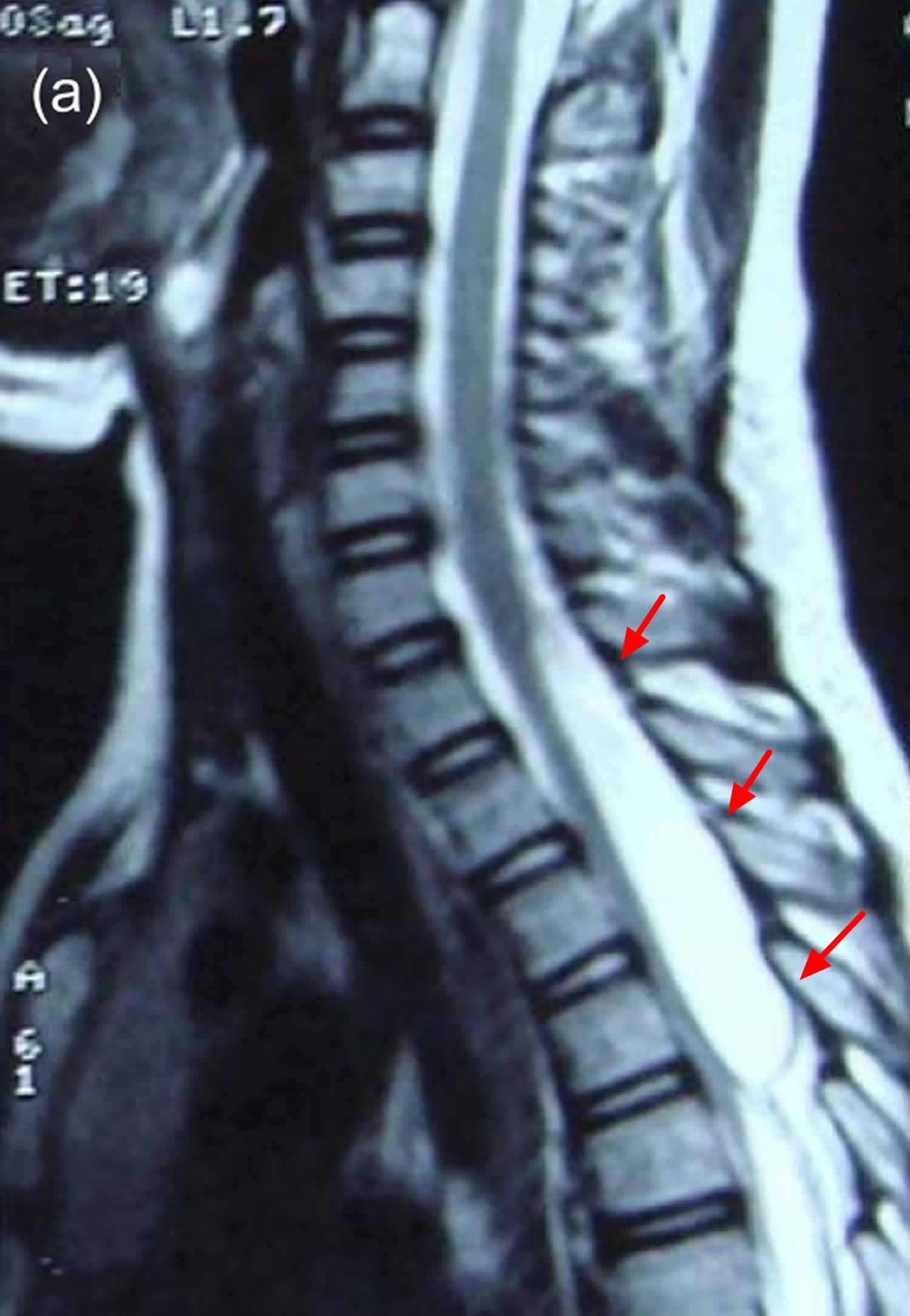 Arachnoid cyst causes, symptoms, diagnosis, prognosis and treatment