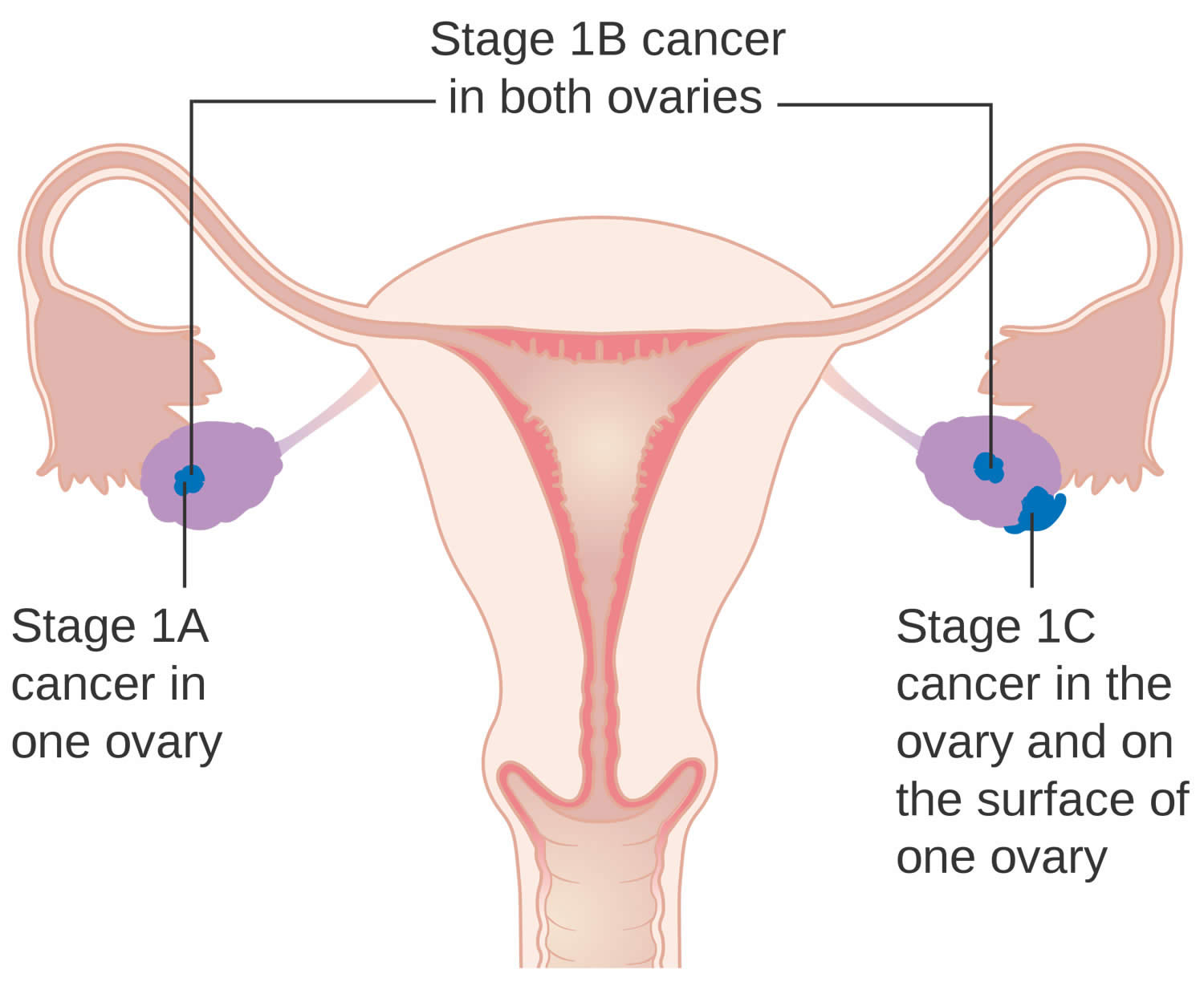 Stage 1 ovarian cancer