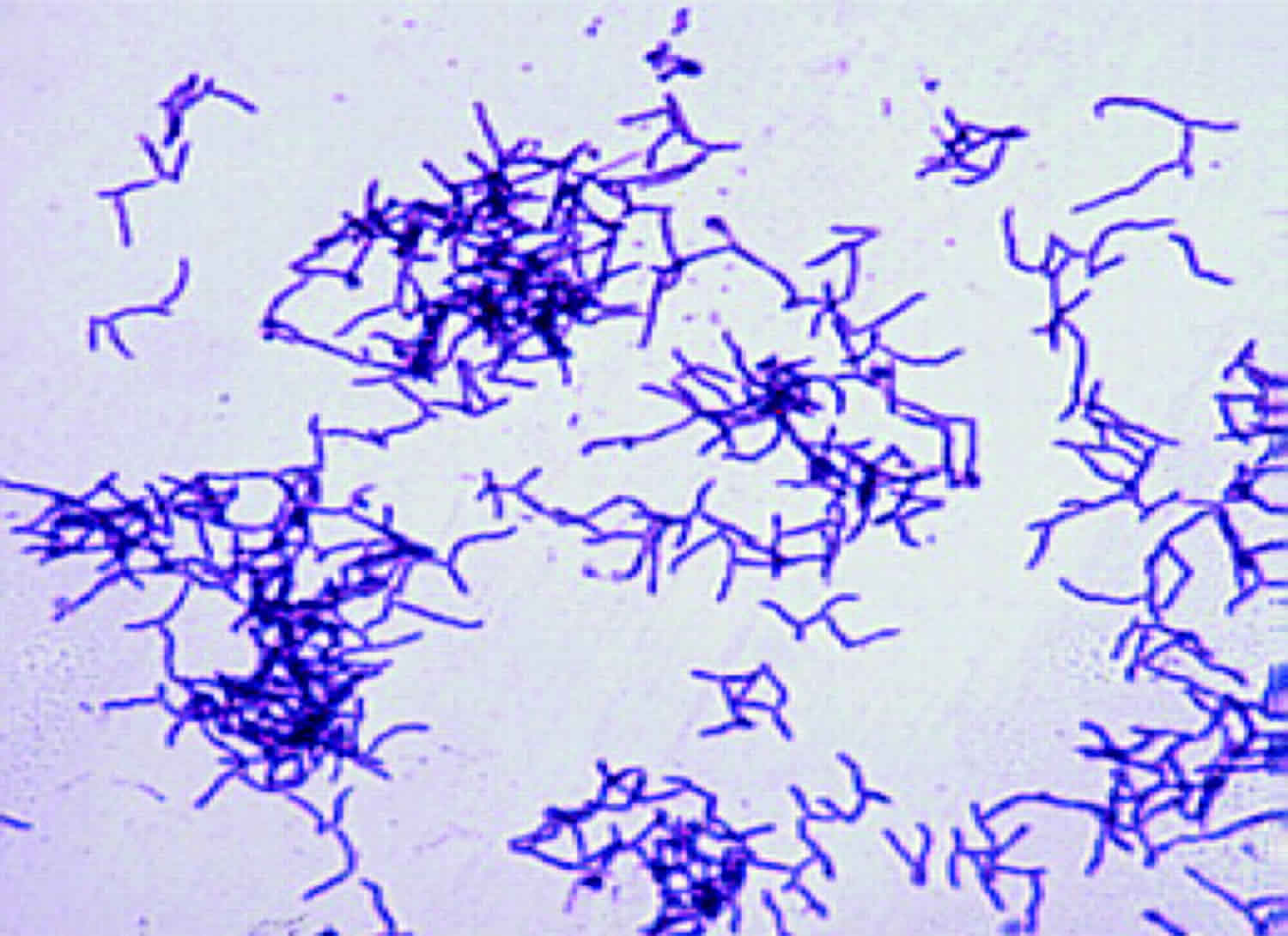 Actinomyces infection, actinomyces diseases and actinomyces treatment