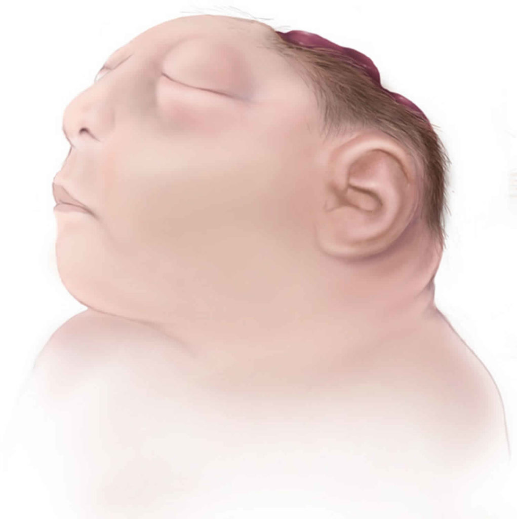 Anencephaly Causes Symptoms Diagnosis Prognosis Anencephaly Treatment   Anencephaly 1 1021x1024 