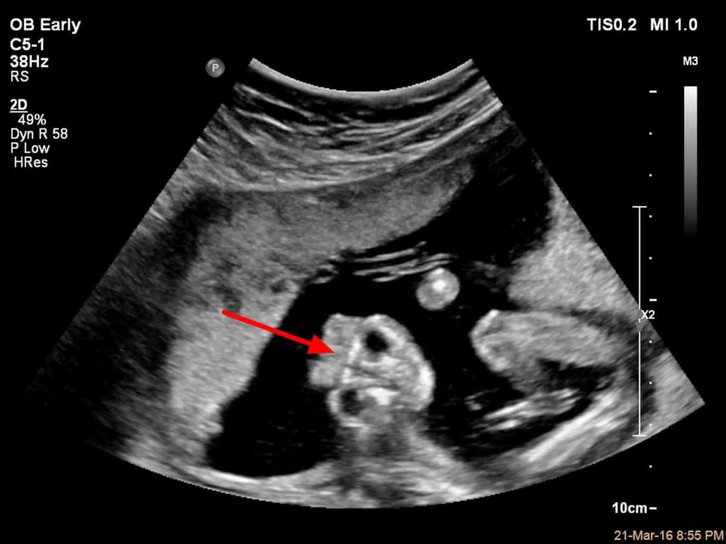 Anencephaly Causes, Symptoms, Diagnosis, Prognosis & Anencephaly Treatment