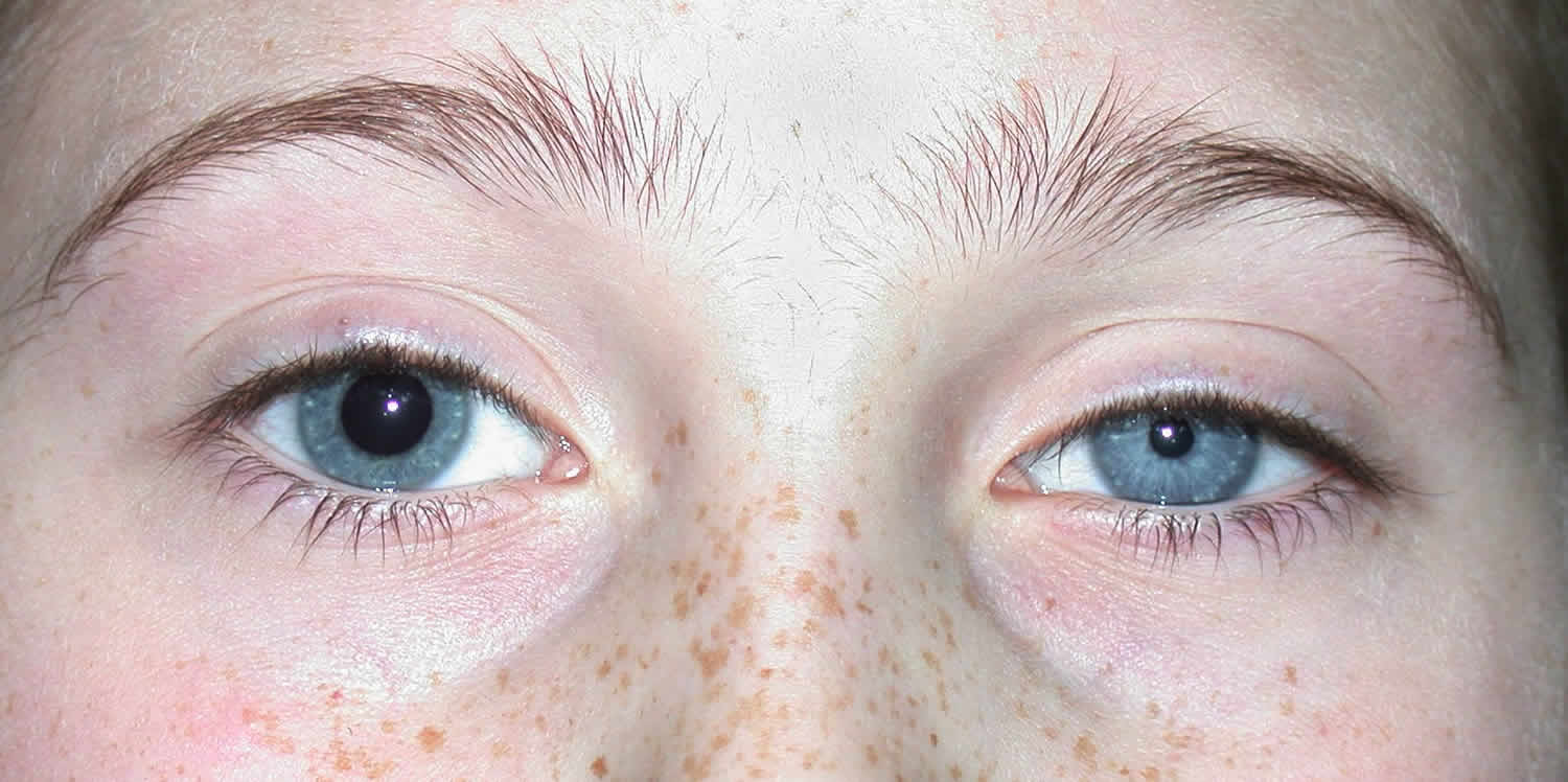 unequal pupil size concussion