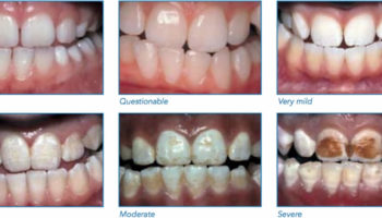 dental fluorosis