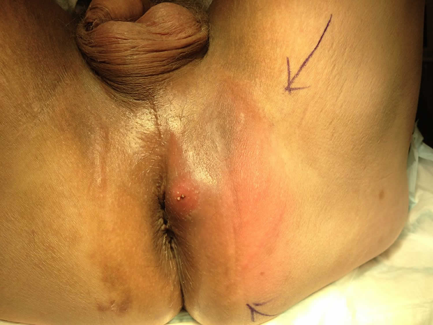 perianal_abscess