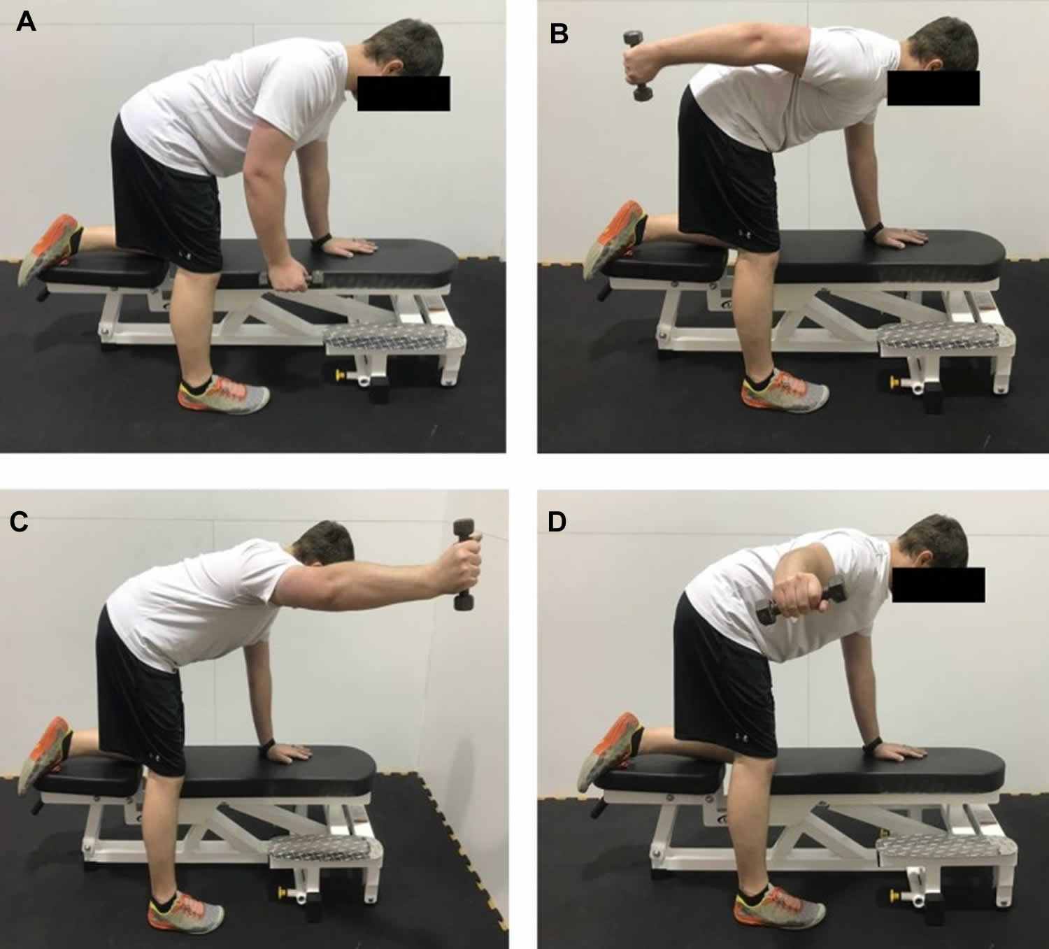 Thoracic Outlet Syndrome Causes Symptoms Diagnosis Exercise And Treatment