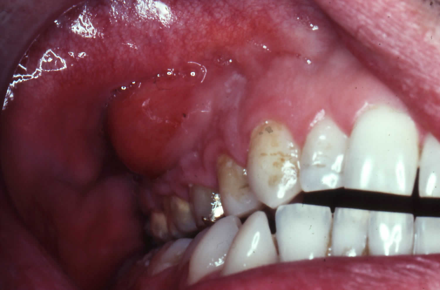 Gum Abscess All About Dental Abscesses Tooth Abscesses And Drainage ...