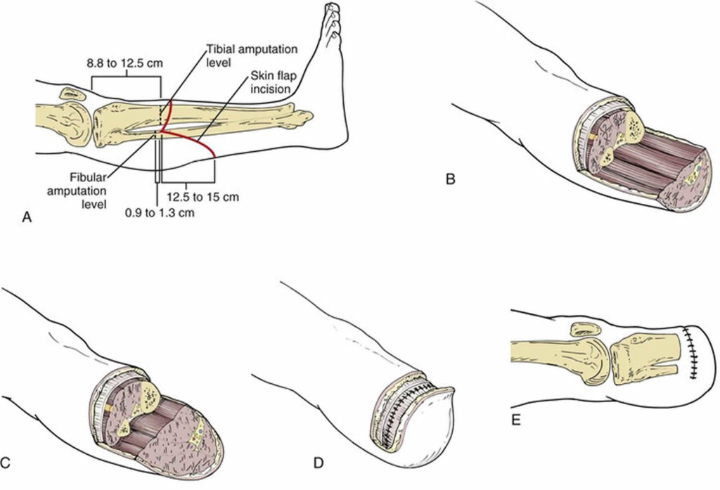 Amputation Causes, Types Of Amputation And Amputation Complications