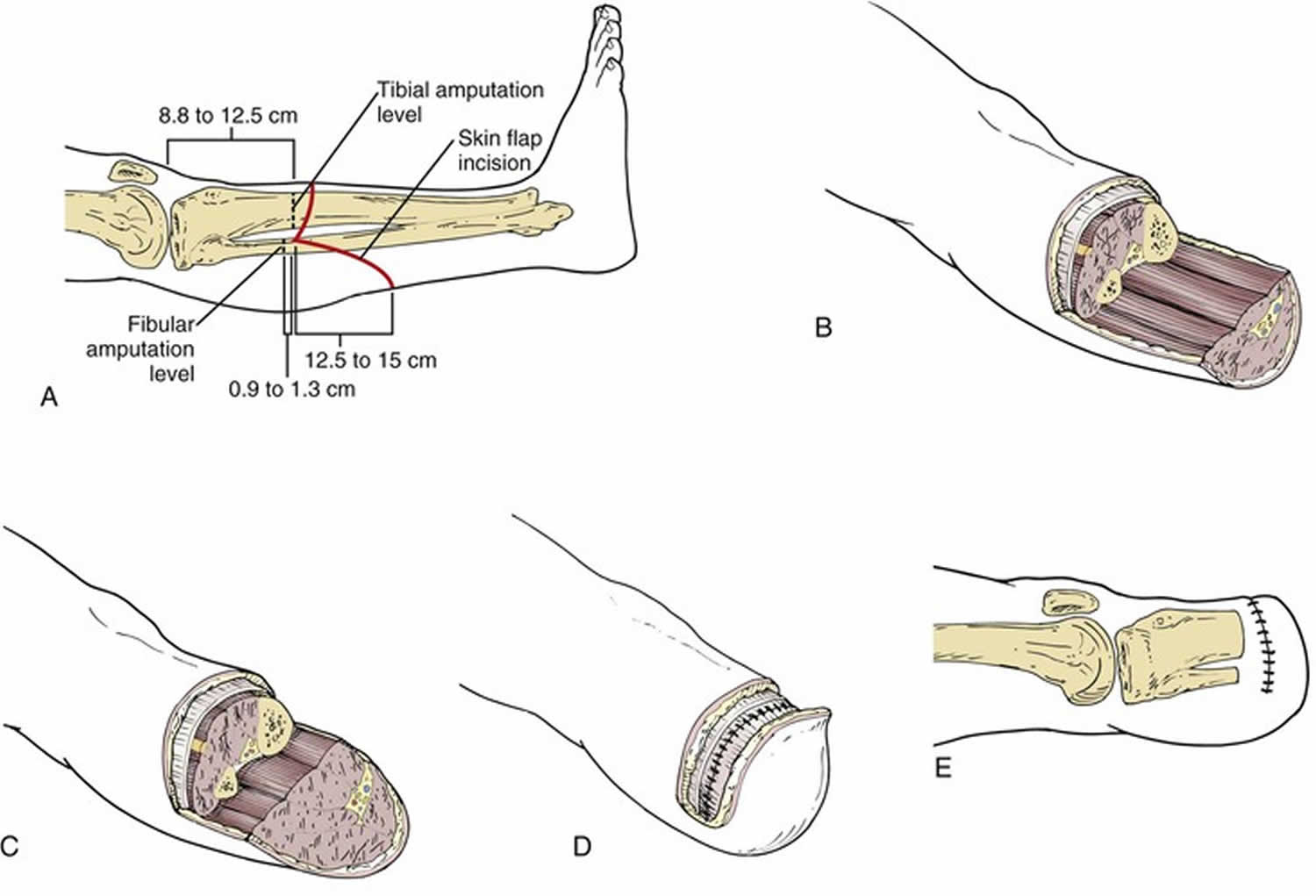 Amputation Causes Types Of Amputation And Amputation Complications