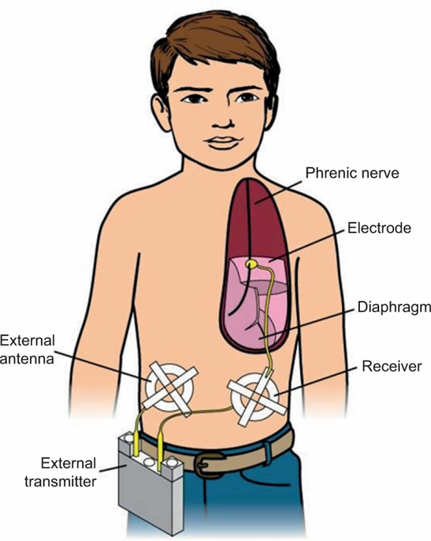 Congenital central hypoventilation syndrome что это