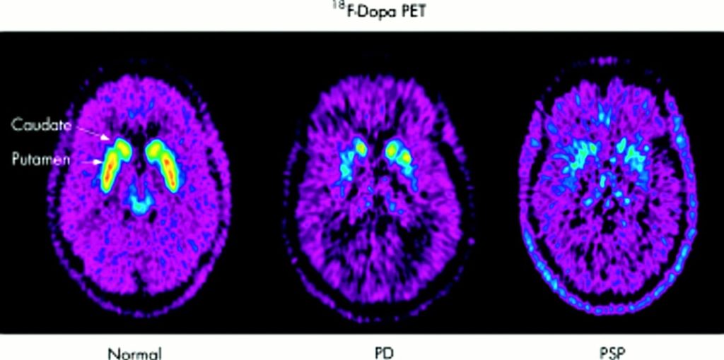 PET scan how does PET scan work, uses and side effects of PET scan