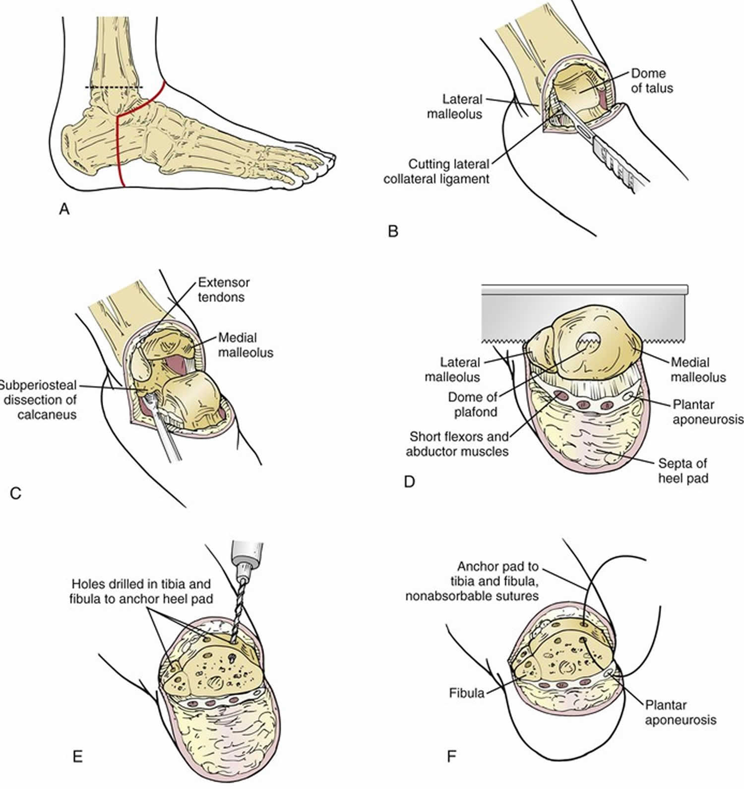 Amputation Causes, Types Of Amputation And Amputation Complications