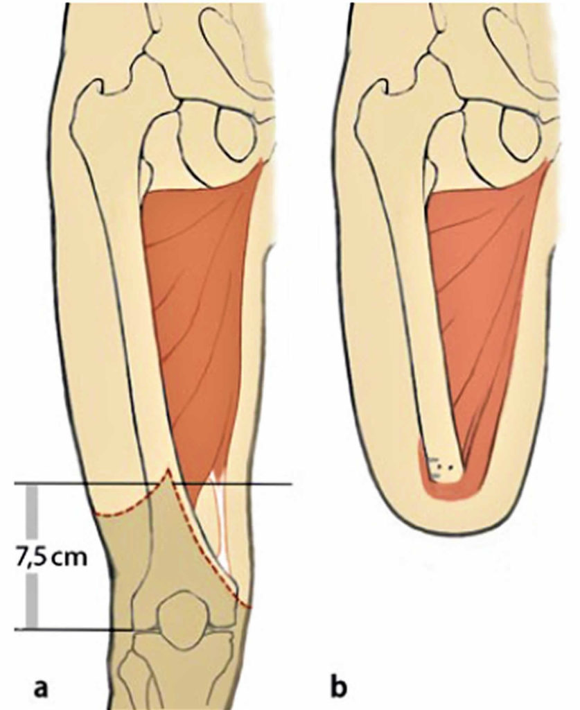 Amputation causes, types of amputation and amputation complications