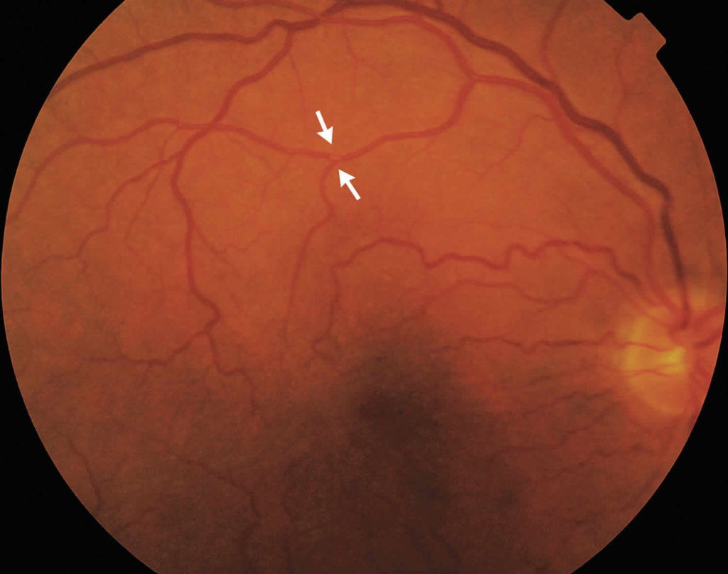Amaurosis fugax causes, symptoms, diagnosis, prognosis and treatment