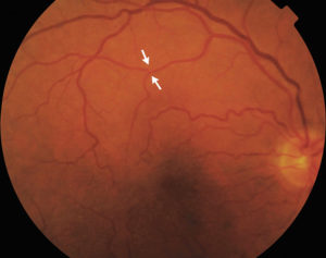 Amaurosis fugax causes, symptoms, diagnosis, prognosis and treatment