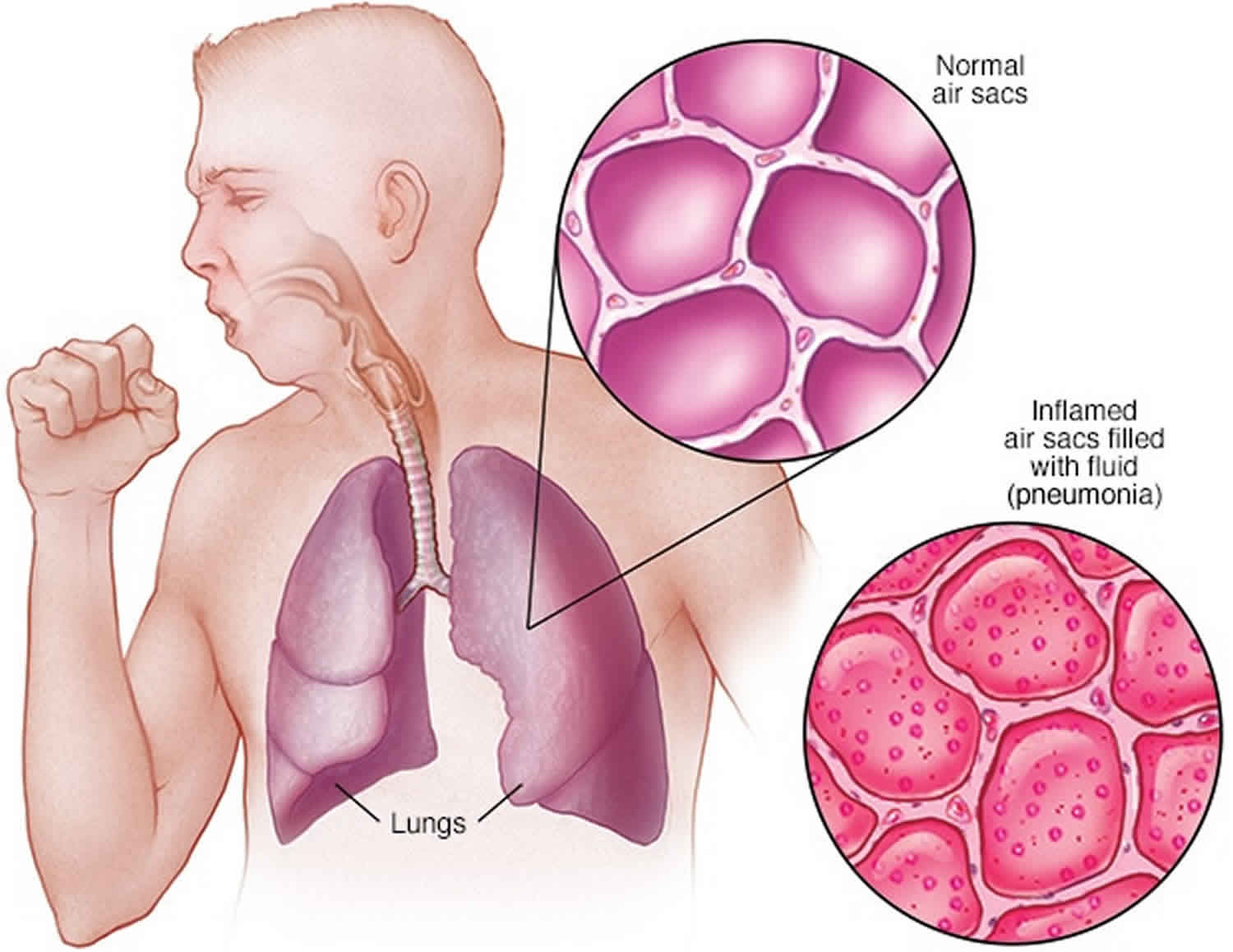 aspiration-lung-aspiration-causes-signs-symptoms-diagnosis-treatment