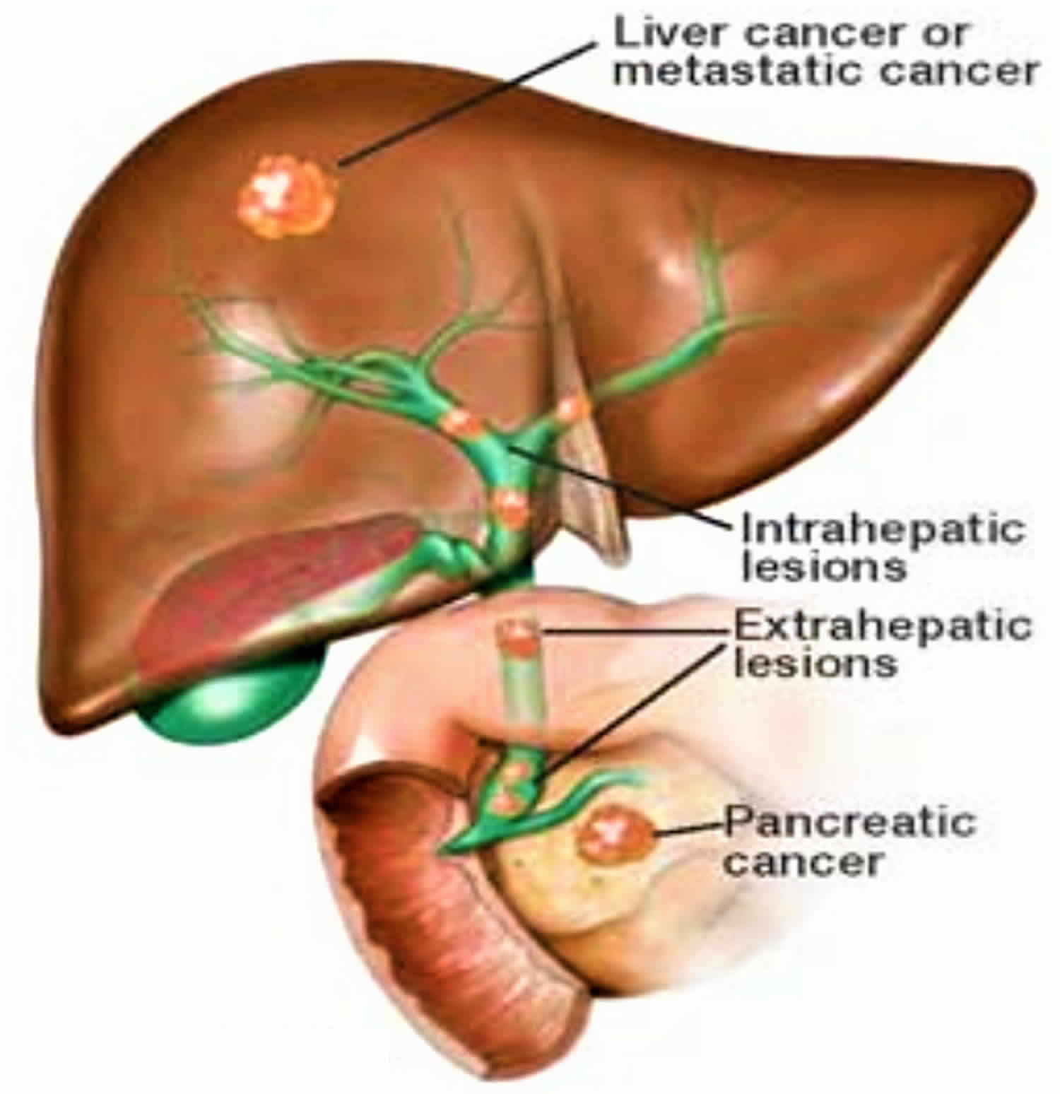 What Would Cause A Blockage In The Bile Duct