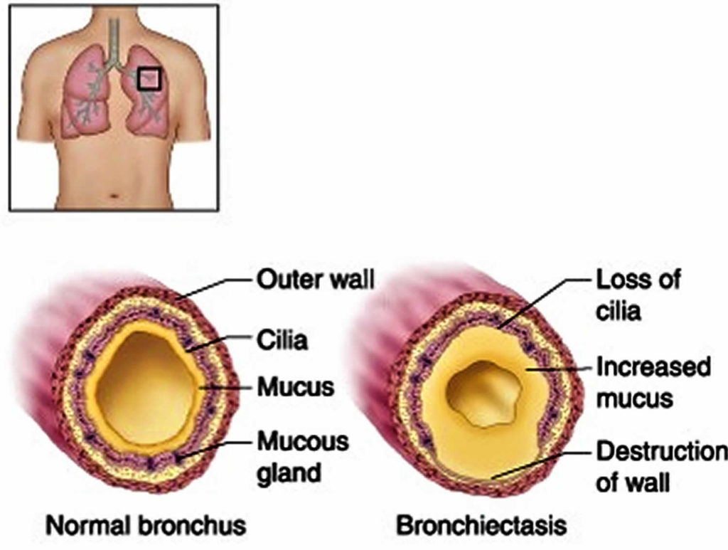 Bronchiectasis Causes Signs Symptoms Diagnosis Prognosis And Treatment 7778