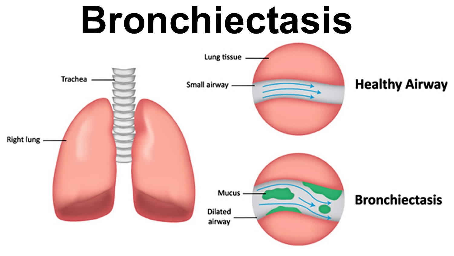 Bronchiectasis Causes Signs Symptoms Diagnosis Prognosis Treatment   Bronchiectasis 