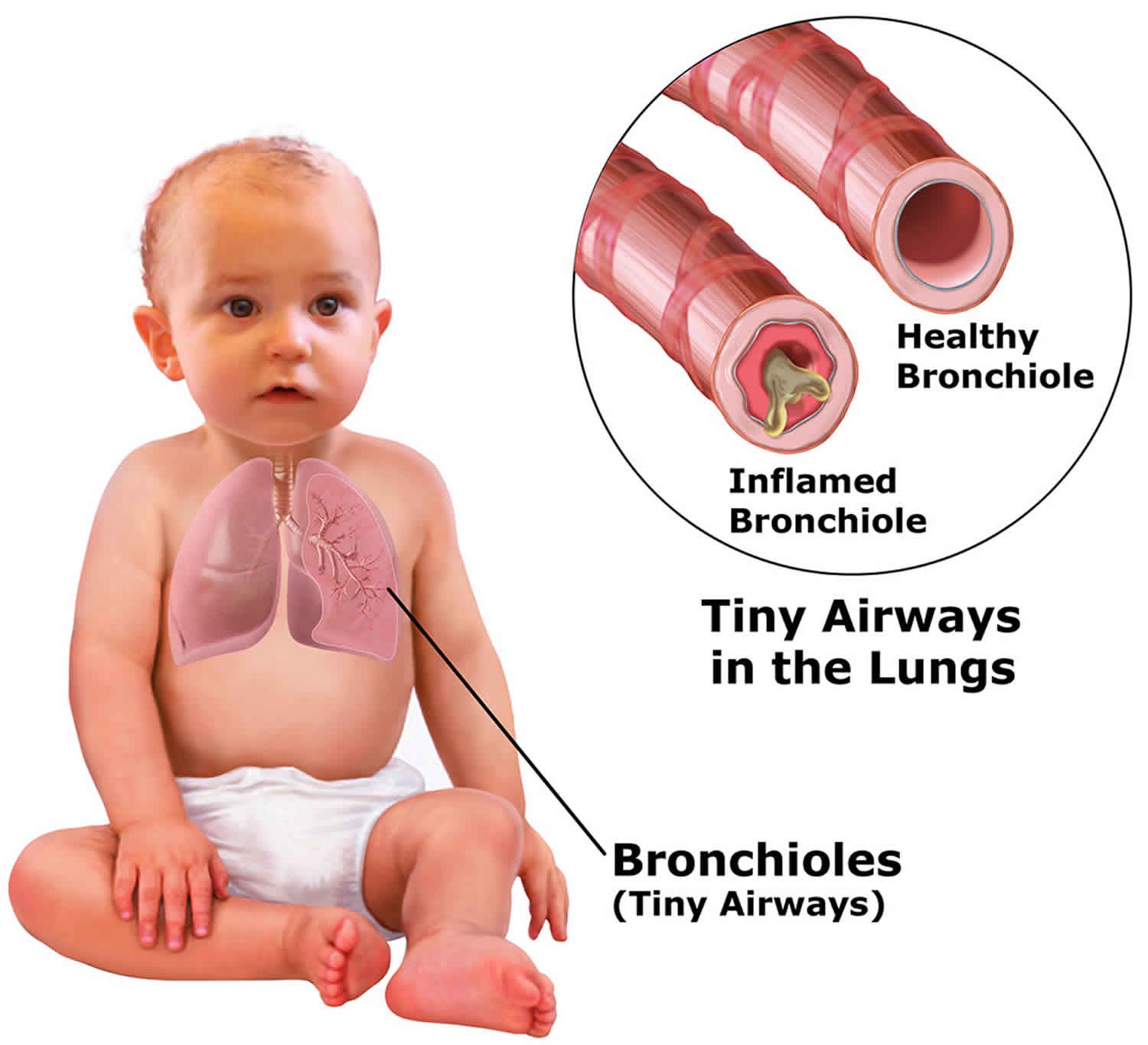 Bronchiolitis Causes Prevention Symptoms Diagnosis And Treatment