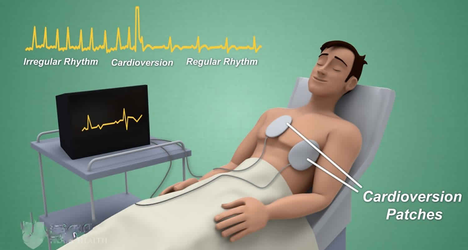 cardioversion-procedure-types-risks-complications-and-success-rate