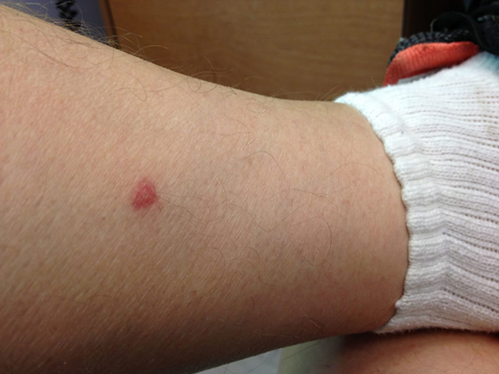 Chigger bites prevention, what chigger bites look like & chigger bites