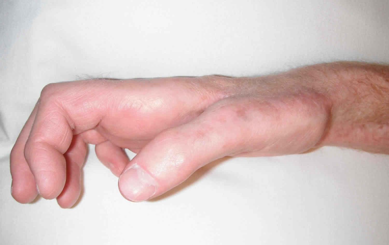 claw-hand-causes-signs-symptoms-diagnosis-and-claw-hand-treatment