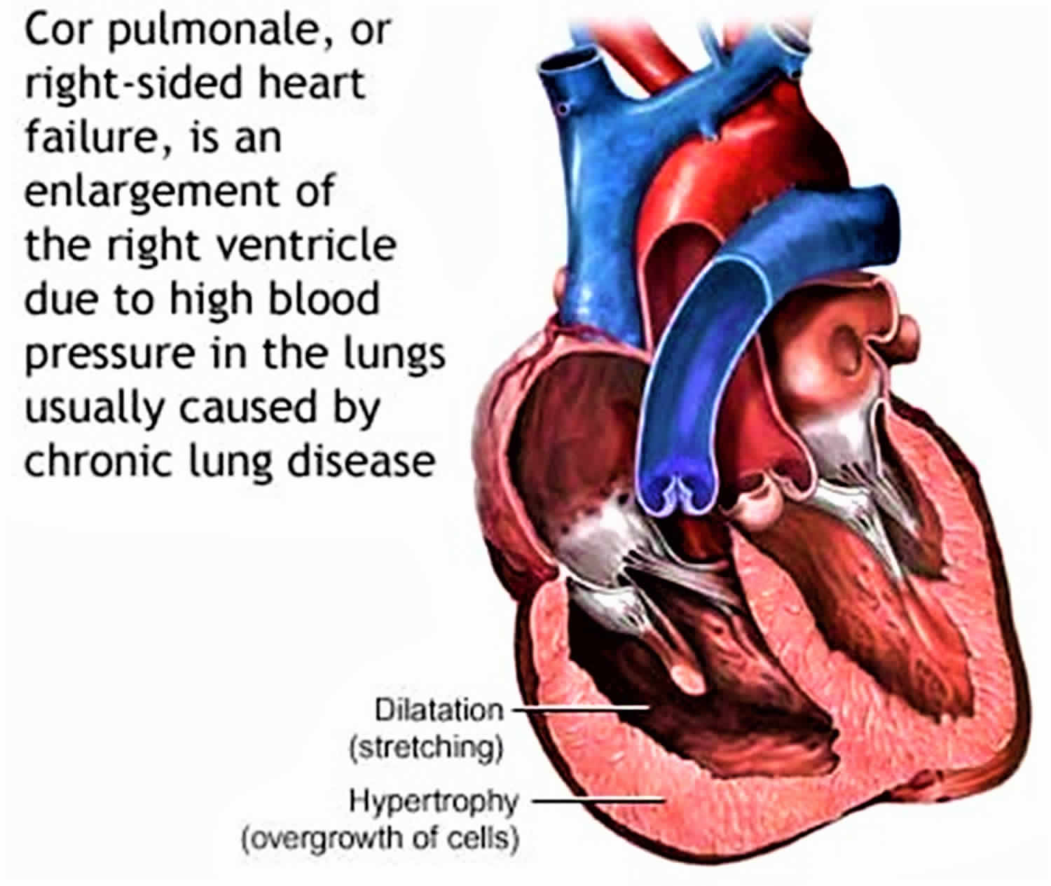 Cor Pulmonale Causes Symptoms Diagnosis Prognosis And Treatment