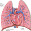 cor pulmonale