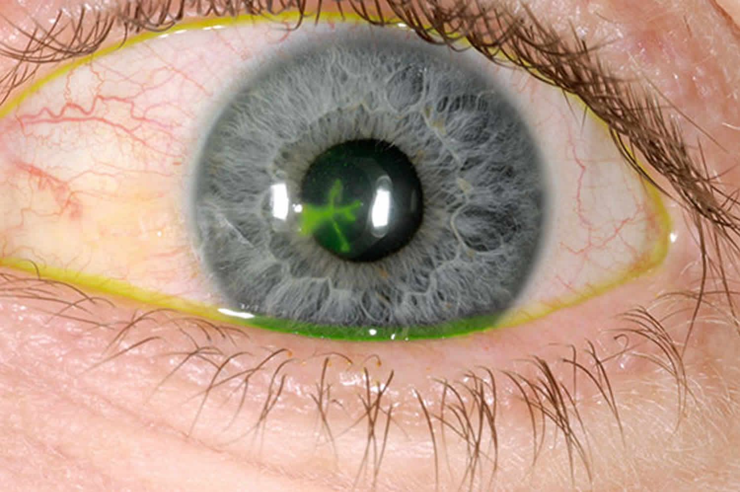 Corneal ulcer and marginal corneal ulcer causes, symptoms & treatment