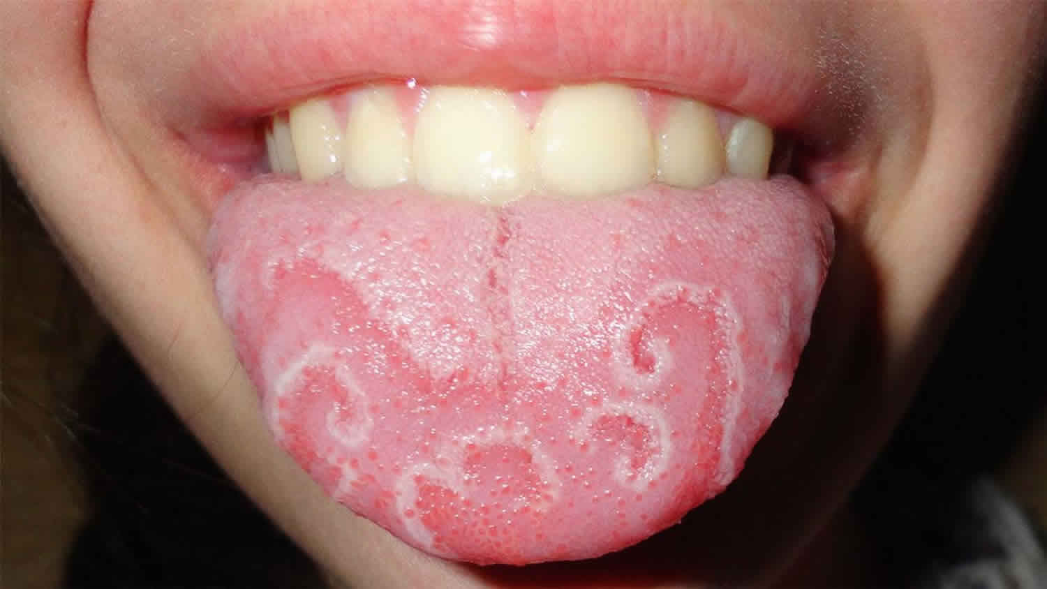 Vitamin B Deficiency Glossitis at James Leith blog