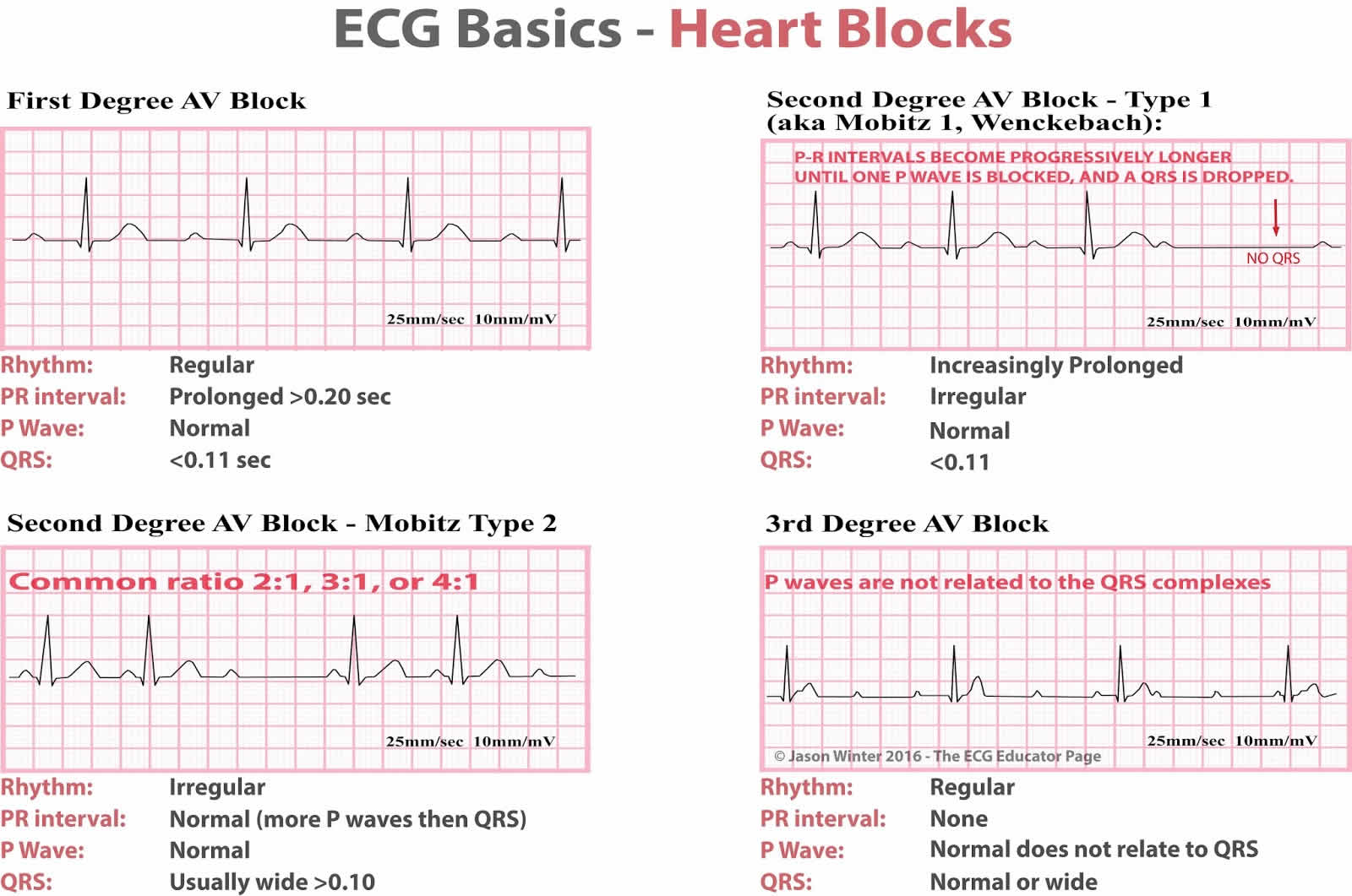 What Is Heart Block