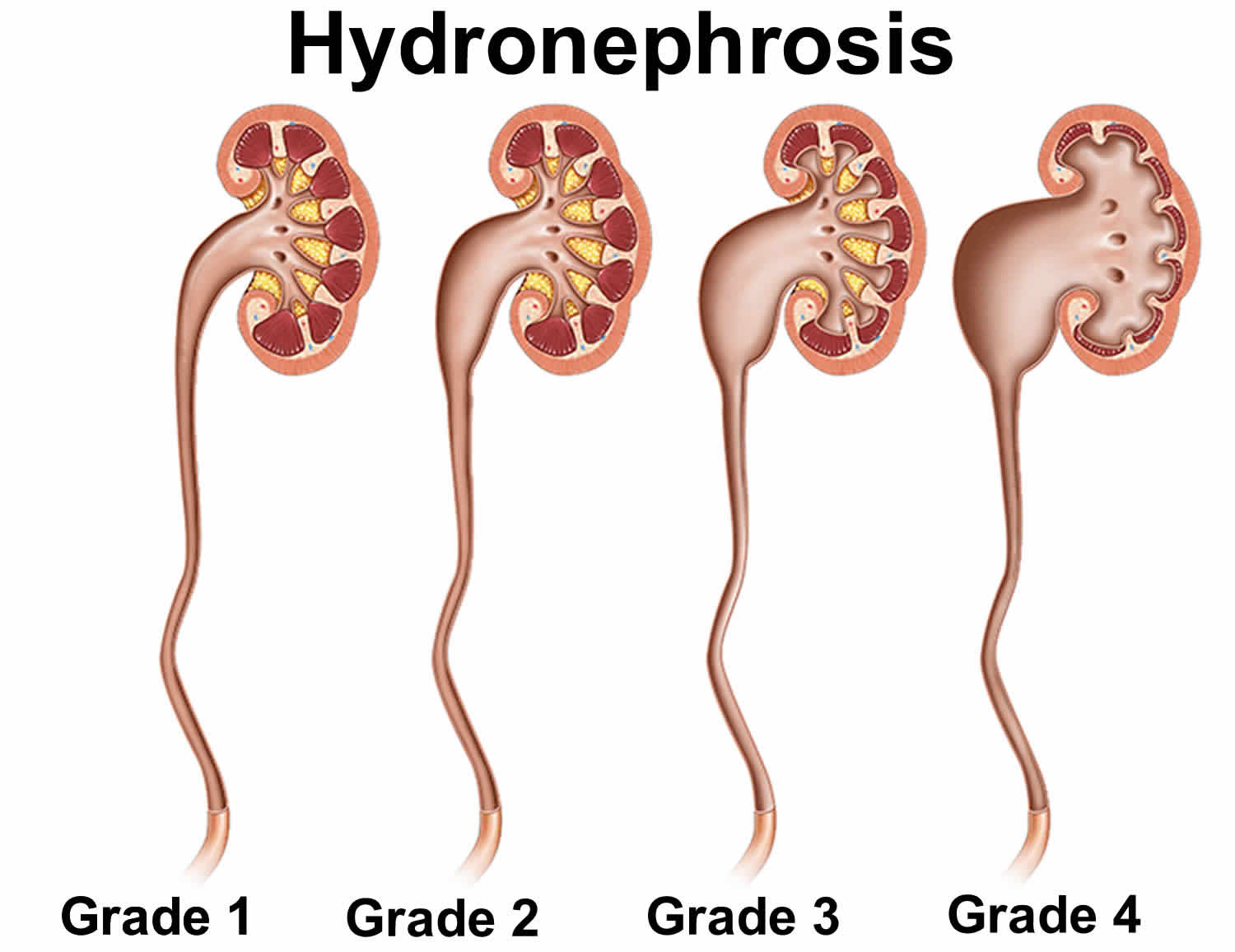 What Are Causes Of Hydronephrosis