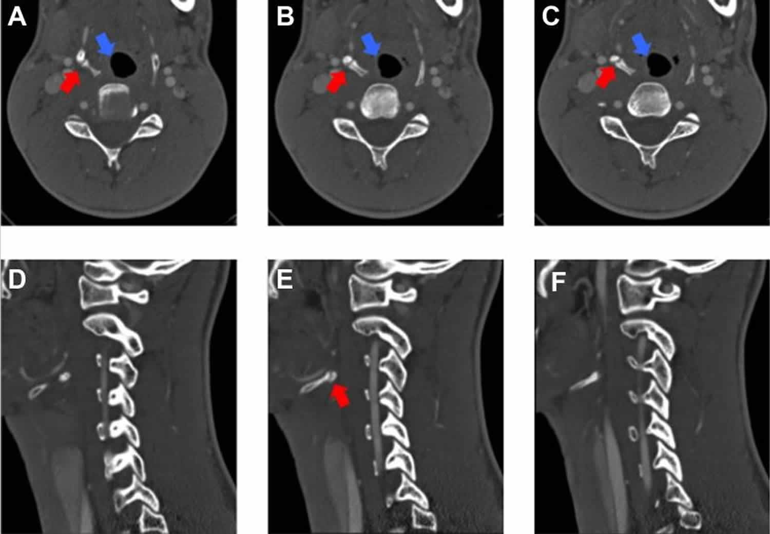 Hyoid bone anatomy, location, dislocation, fracture & hyoid bone syndrome